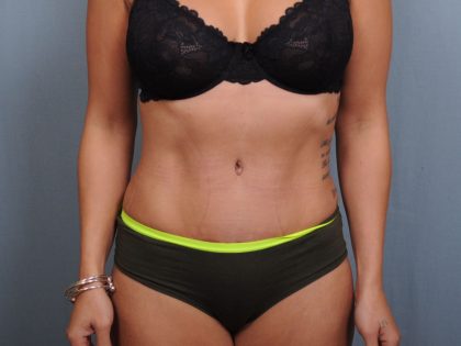 Abdominoplasty Before & After Patient #1405