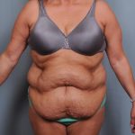 Abdominoplasty Before & After Patient #1466