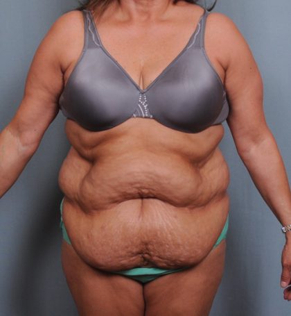 Abdominoplasty Before & After Patient #1466