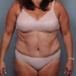 Abdominoplasty Before & After Patient #1466