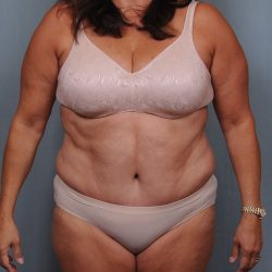 Abdominoplasty Before & After Patient #1466