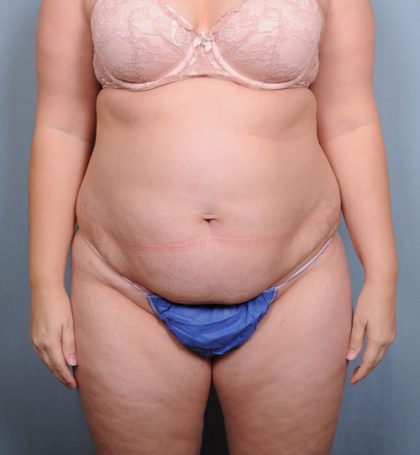 Abdominoplasty Before & After Patient #1465