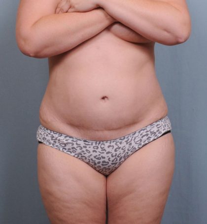 Abdominoplasty Before & After Patient #1465