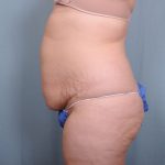 Abdominoplasty Before & After Patient #1465