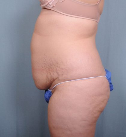 Abdominoplasty Before & After Patient #1465