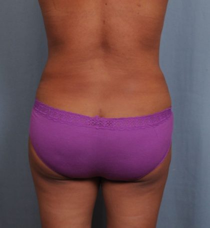 Brazilian Butt Lift Before & After Patient #1464