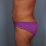 Brazilian Butt Lift Before & After Patient #1464