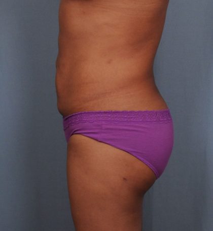 Brazilian Butt Lift Before & After Patient #1464
