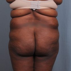Brazilian Butt Lift Before & After Patient #1463
