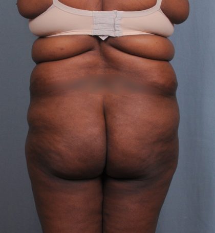 Brazilian Butt Lift Before & After Patient #1463