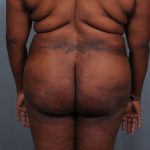 Brazilian Butt Lift Before & After Patient #1463