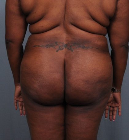 Brazilian Butt Lift Before & After Patient #1463