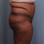 Brazilian Butt Lift Before & After Patient #1463