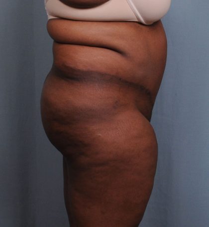 Brazilian Butt Lift Before & After Patient #1463
