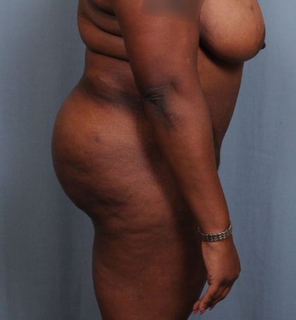 Brazilian Butt Lift Before & After Patient #1463