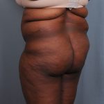 Brazilian Butt Lift Before & After Patient #1463