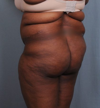 Brazilian Butt Lift Before & After Patient #1463