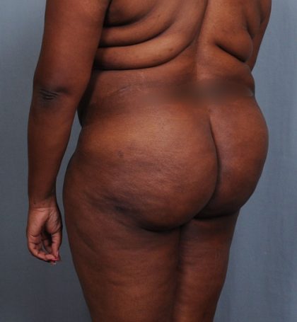 Brazilian Butt Lift Before & After Patient #1463
