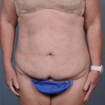 Abdominoplasty Before & After Patient #1902