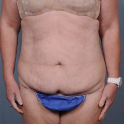 Abdominoplasty Before & After Patient #1902