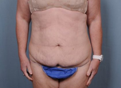 Abdominoplasty Before & After Patient #1902