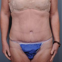 Abdominoplasty Before & After Patient #1902