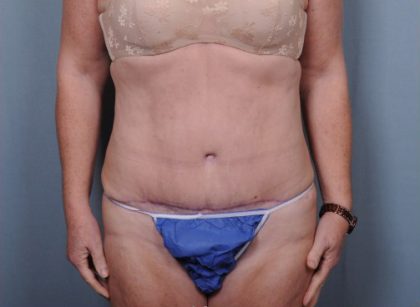 Abdominoplasty Before & After Patient #1902