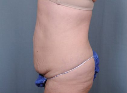 Abdominoplasty Before & After Patient #1902