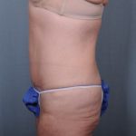 Abdominoplasty Before & After Patient #1902