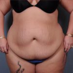 Abdominoplasty Before & After Patient #1900