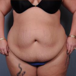 Abdominoplasty Before & After Patient #1900