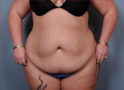 Abdominoplasty Before & After Patient #1900