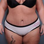 Abdominoplasty Before & After Patient #1900