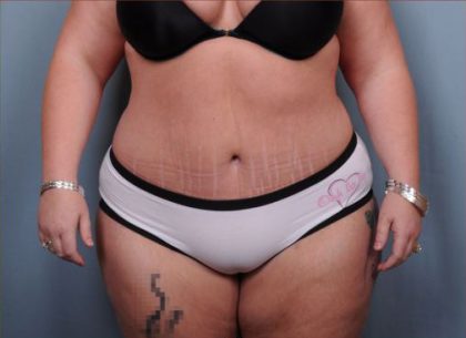 Abdominoplasty Before & After Patient #1900