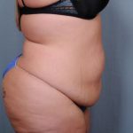 Abdominoplasty Before & After Patient #1900
