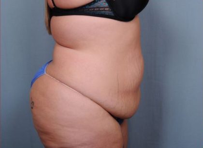 Abdominoplasty Before & After Patient #1900