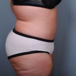 Abdominoplasty Before & After Patient #1900