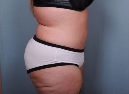 Abdominoplasty Before & After Patient #1900