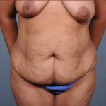 Abdominoplasty Before & After Patient #1899