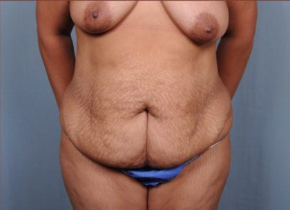 Abdominoplasty Before & After Patient #1899