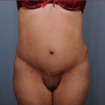 Abdominoplasty Before & After Patient #1899