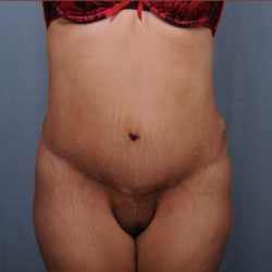 Abdominoplasty Before & After Patient #1899