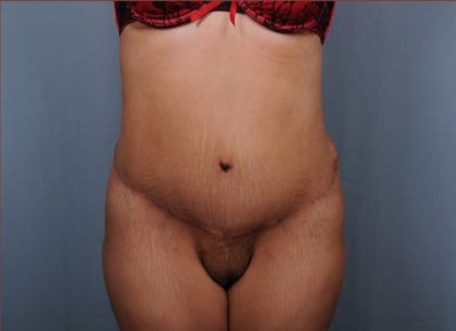 Abdominoplasty Before & After Patient #1899