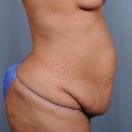 Abdominoplasty Before & After Patient #1899