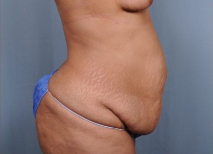 Abdominoplasty Before & After Patient #1899