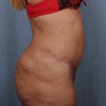 Abdominoplasty Before & After Patient #1899