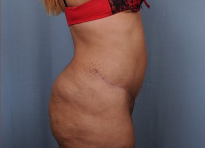 Abdominoplasty Before & After Patient #1899