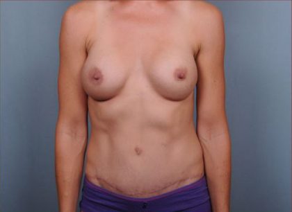 Abdominoplasty Before & After Patient #1898