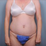 Abdominoplasty Before & After Patient #1896