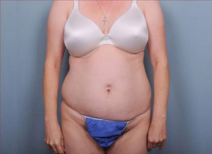 Abdominoplasty Before & After Patient #1896